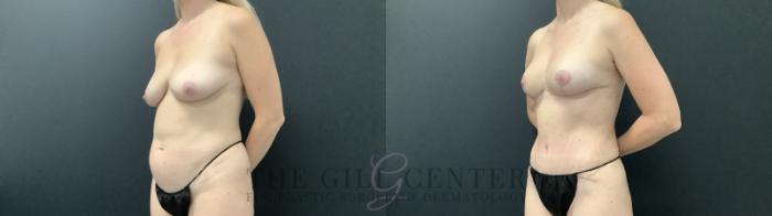 Mommy Makeover Case 686 Before & After Left Side | The Woodlands, TX | The Gill Center for Plastic Surgery and Dermatology