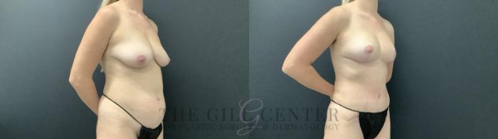 Mommy Makeover Case 686 Before & After Right Side | The Woodlands, TX | The Gill Center for Plastic Surgery and Dermatology