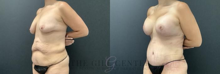 Mommy Makeover Case 696 Before & After Left Side | The Woodlands, TX | The Gill Center for Plastic Surgery and Dermatology