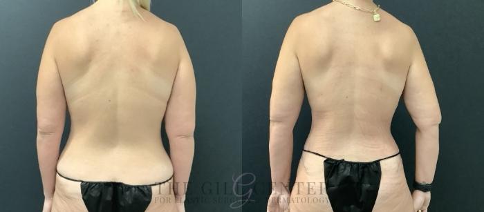 Mommy Makeover Case 703 Before & After Back | The Woodlands, TX | The Gill Center for Plastic Surgery and Dermatology