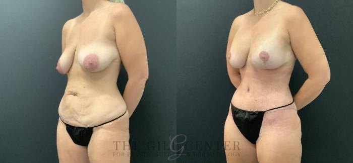 Mommy Makeover Case 703 Before & After Left Side | The Woodlands, TX | The Gill Center for Plastic Surgery and Dermatology