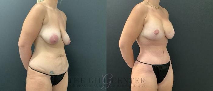 Mommy Makeover Case 703 Before & After Right Side | The Woodlands, TX | The Gill Center for Plastic Surgery and Dermatology