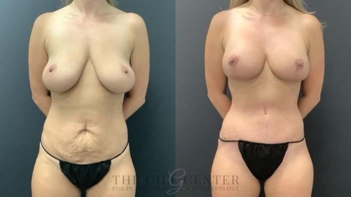 Mommy Makeover Case 712 Before & After Front | The Woodlands, TX | The Gill Center for Plastic Surgery and Dermatology