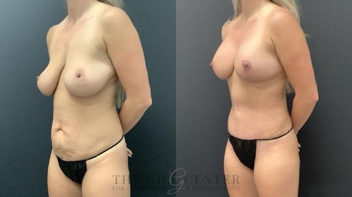 Mommy Makeover Case 712 Before & After Left Side | The Woodlands, TX | The Gill Center for Plastic Surgery and Dermatology