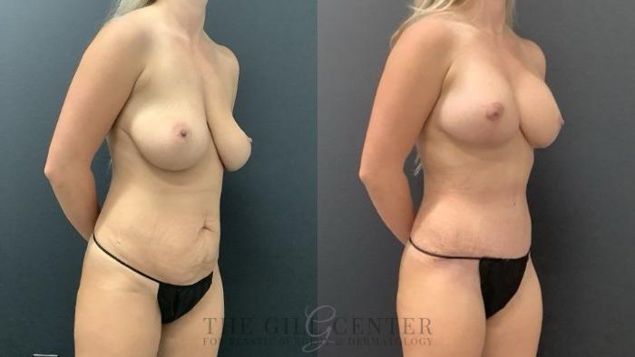 Mommy Makeover Case 712 Before & After Right Side | The Woodlands, TX | The Gill Center for Plastic Surgery and Dermatology