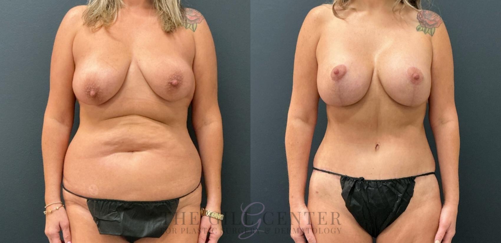 Mommy Makeover Case 770 Before & After Front | The Woodlands, TX | The Gill Center for Plastic Surgery and Dermatology