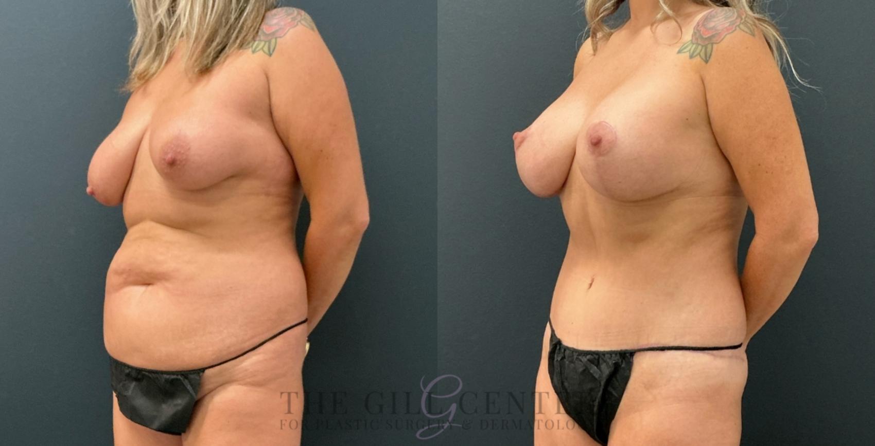 Mommy Makeover Case 770 Before & After Left Oblique | The Woodlands, TX | The Gill Center for Plastic Surgery and Dermatology