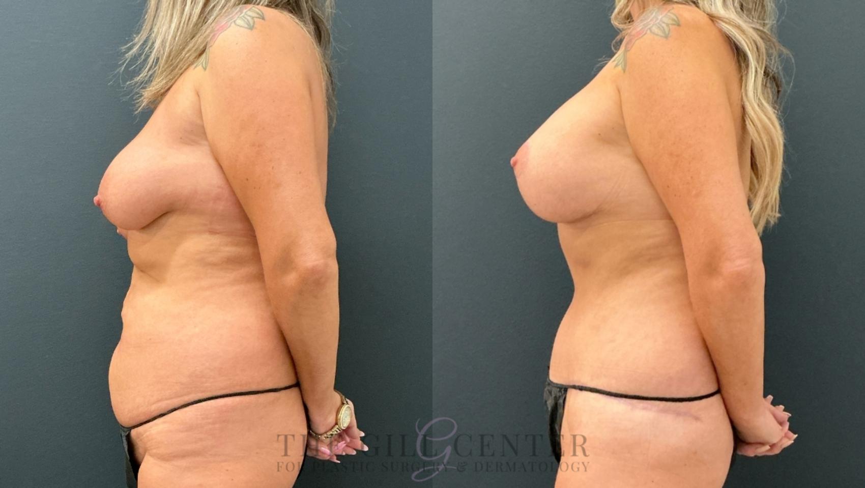 Mommy Makeover Case 770 Before & After Left Side | The Woodlands, TX | The Gill Center for Plastic Surgery and Dermatology