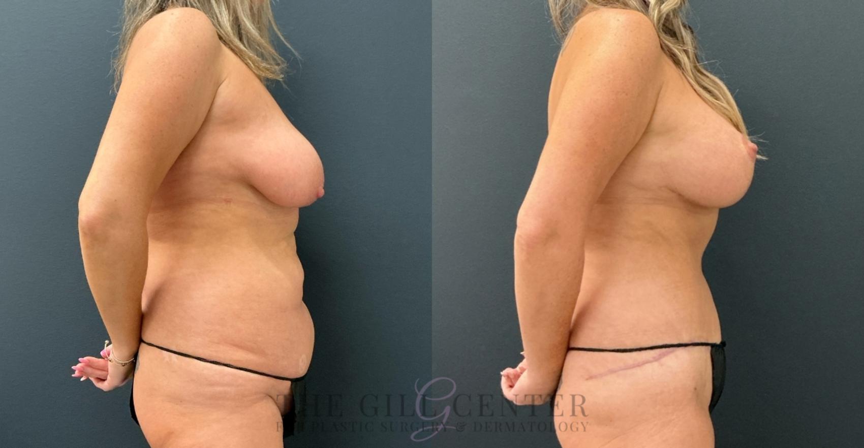 Mommy Makeover Case 770 Before & After Right Side | The Woodlands, TX | The Gill Center for Plastic Surgery and Dermatology