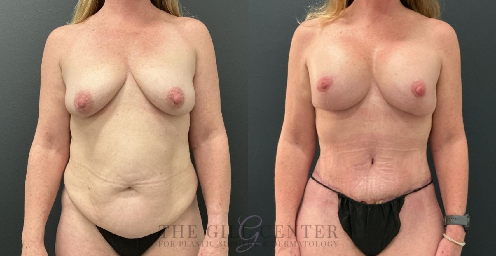 Mommy Makeover Case 773 Before & After Front | The Woodlands, TX | The Gill Center for Plastic Surgery and Dermatology