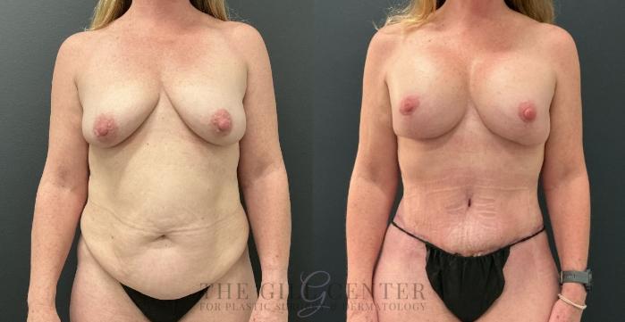 Mommy Makeover Case 773 Before & After Front | The Woodlands, TX | The Gill Center for Plastic Surgery and Dermatology