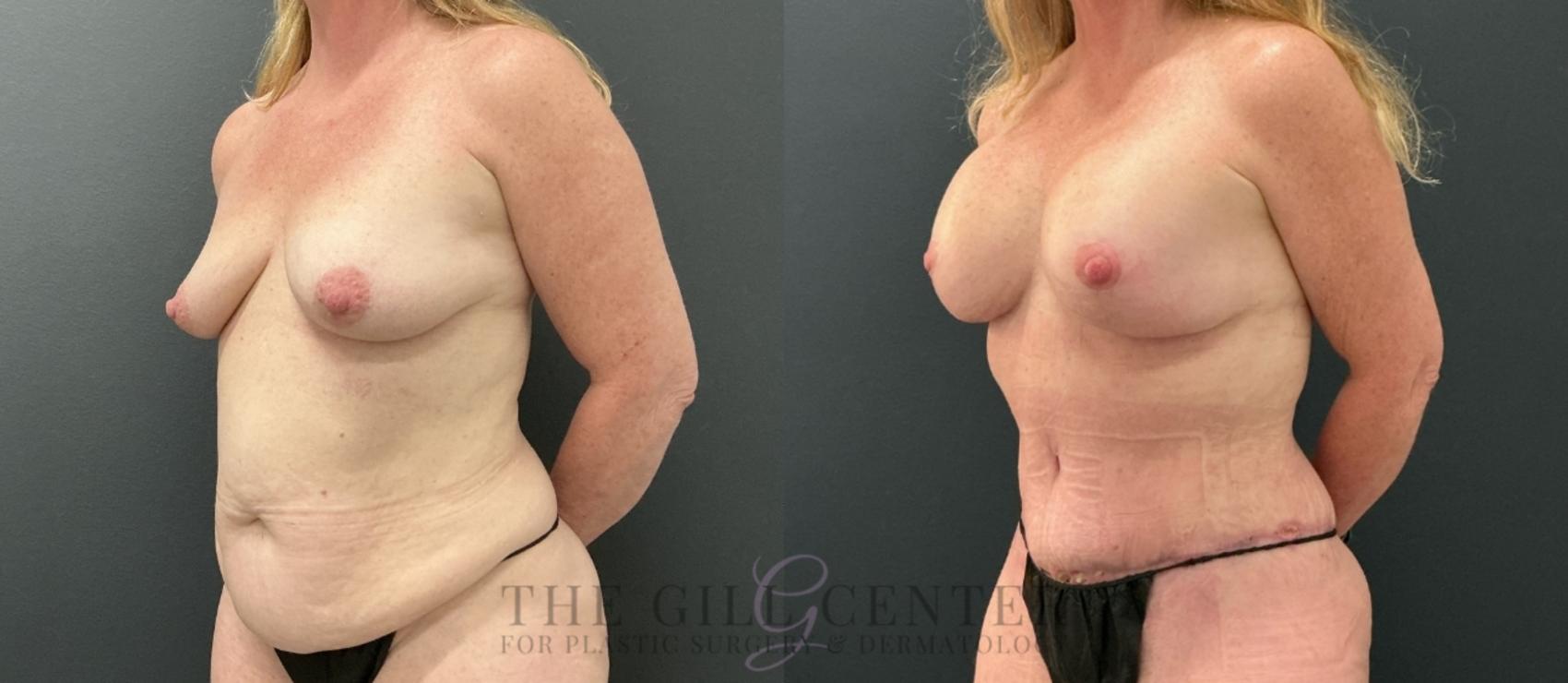 Mommy Makeover Case 773 Before & After Left Oblique | The Woodlands, TX | The Gill Center for Plastic Surgery and Dermatology