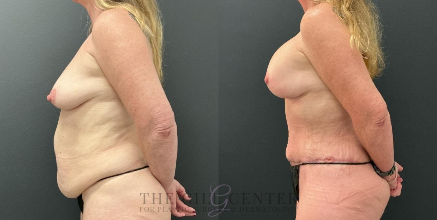 Mommy Makeover Case 773 Before & After Left Side | The Woodlands, TX | The Gill Center for Plastic Surgery and Dermatology