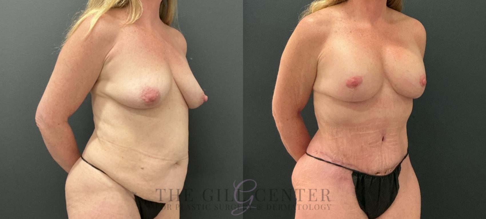 Mommy Makeover Case 773 Before & After Right Oblique | The Woodlands, TX | The Gill Center for Plastic Surgery and Dermatology
