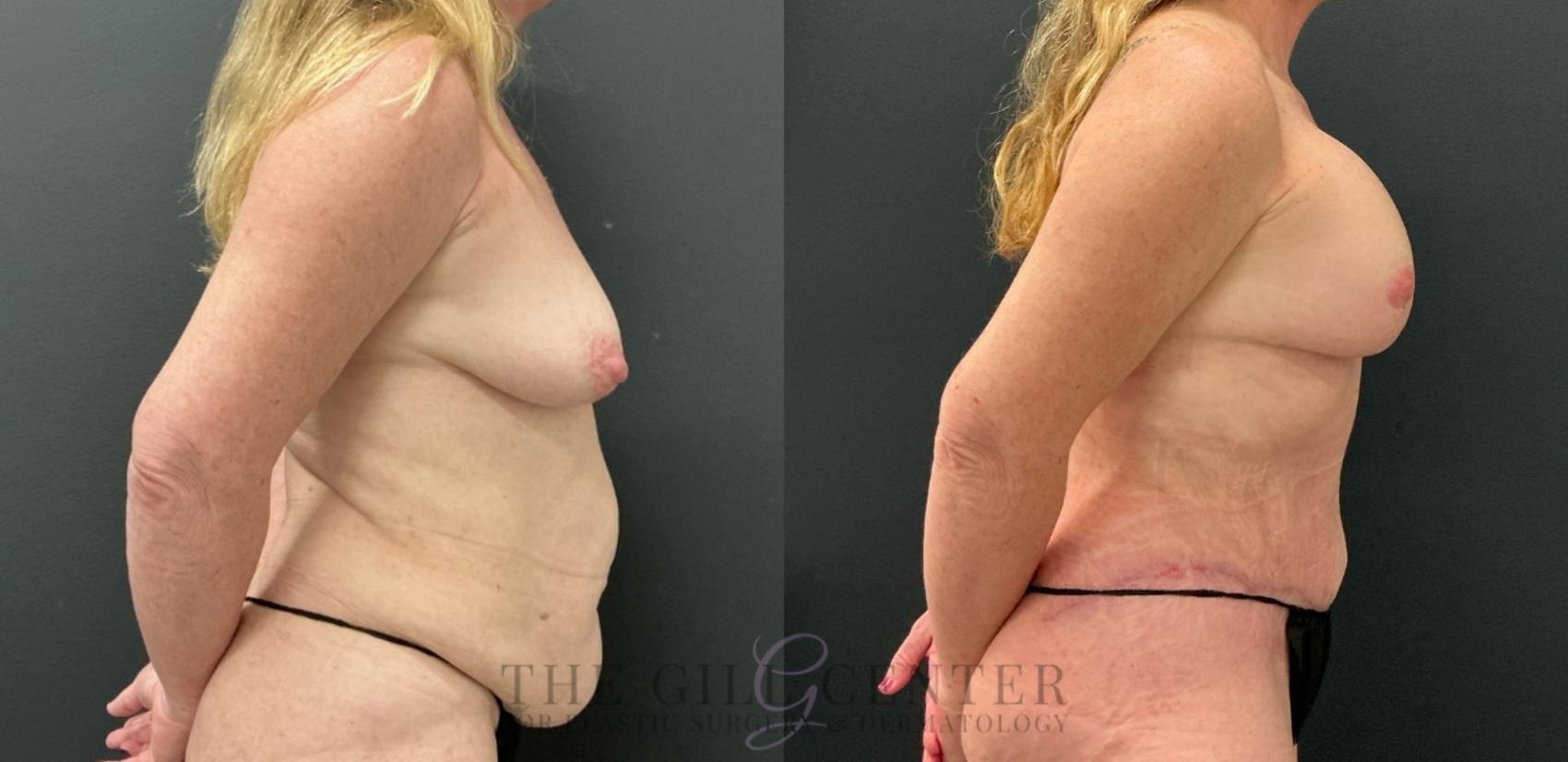 Mommy Makeover Case 773 Before & After Right Side | The Woodlands, TX | The Gill Center for Plastic Surgery and Dermatology