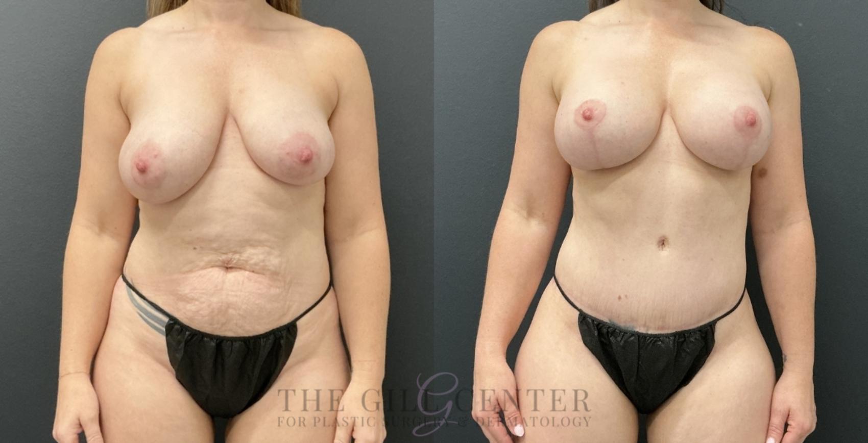 Mommy Makeover Case 775 Before & After Front | The Woodlands, TX | The Gill Center for Plastic Surgery and Dermatology