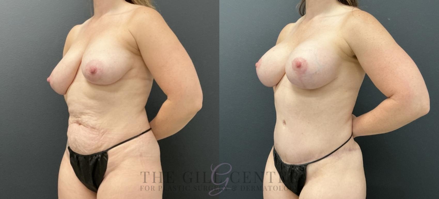 Mommy Makeover Case 775 Before & After Left Oblique | The Woodlands, TX | The Gill Center for Plastic Surgery and Dermatology