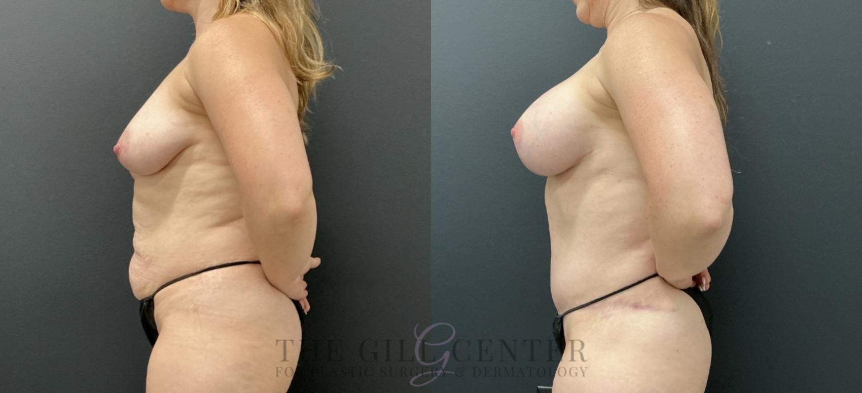Mommy Makeover Case 775 Before & After Left Side | The Woodlands, TX | The Gill Center for Plastic Surgery and Dermatology
