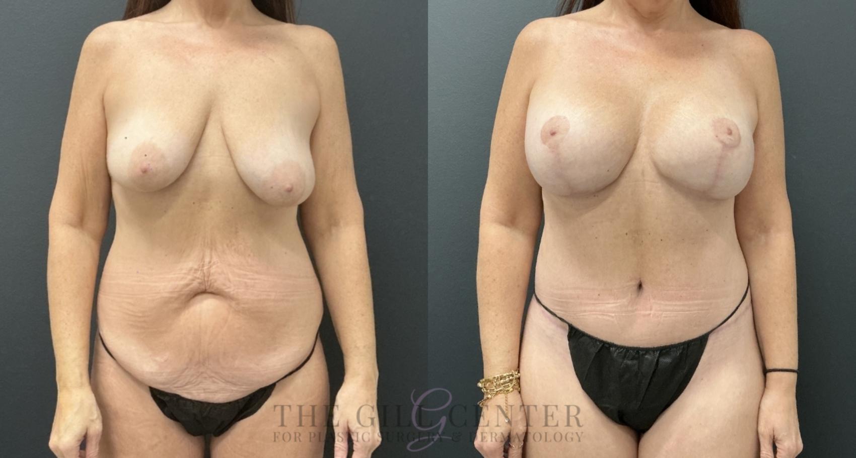 Mommy Makeover Case 776 Before & After Front | The Woodlands, TX | The Gill Center for Plastic Surgery and Dermatology