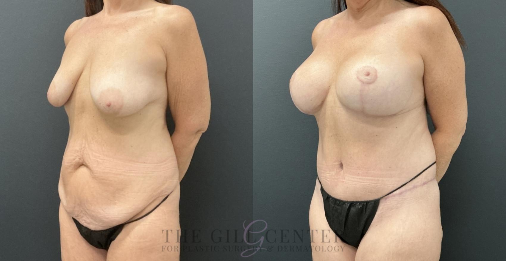 Mommy Makeover Case 776 Before & After Left Oblique | The Woodlands, TX | The Gill Center for Plastic Surgery and Dermatology