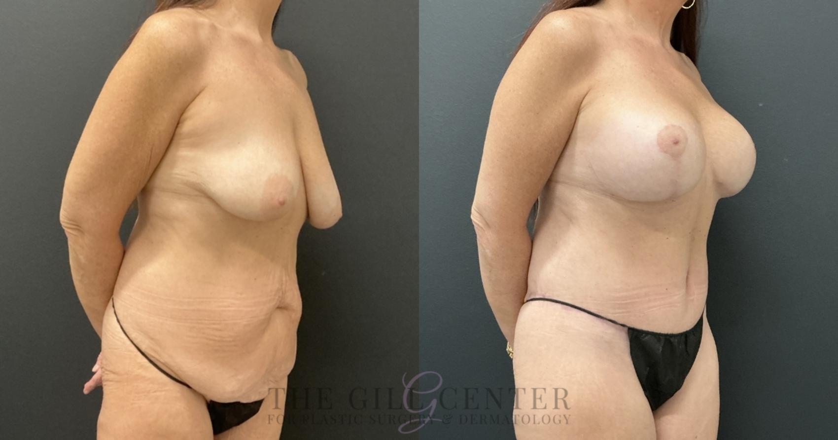 Mommy Makeover Case 776 Before & After Right Oblique | The Woodlands, TX | The Gill Center for Plastic Surgery and Dermatology