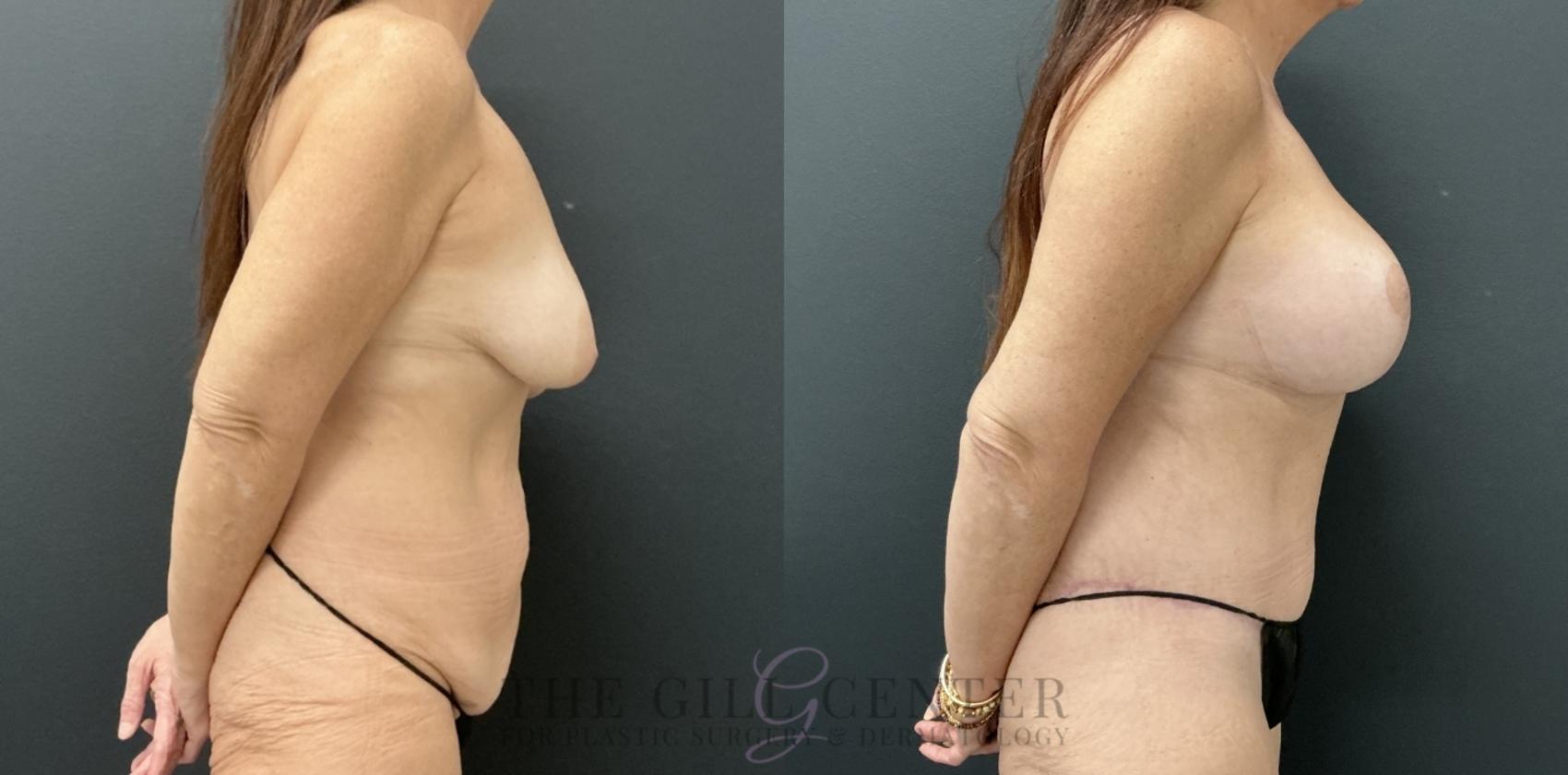 Mommy Makeover Case 776 Before & After Right Side | The Woodlands, TX | The Gill Center for Plastic Surgery and Dermatology