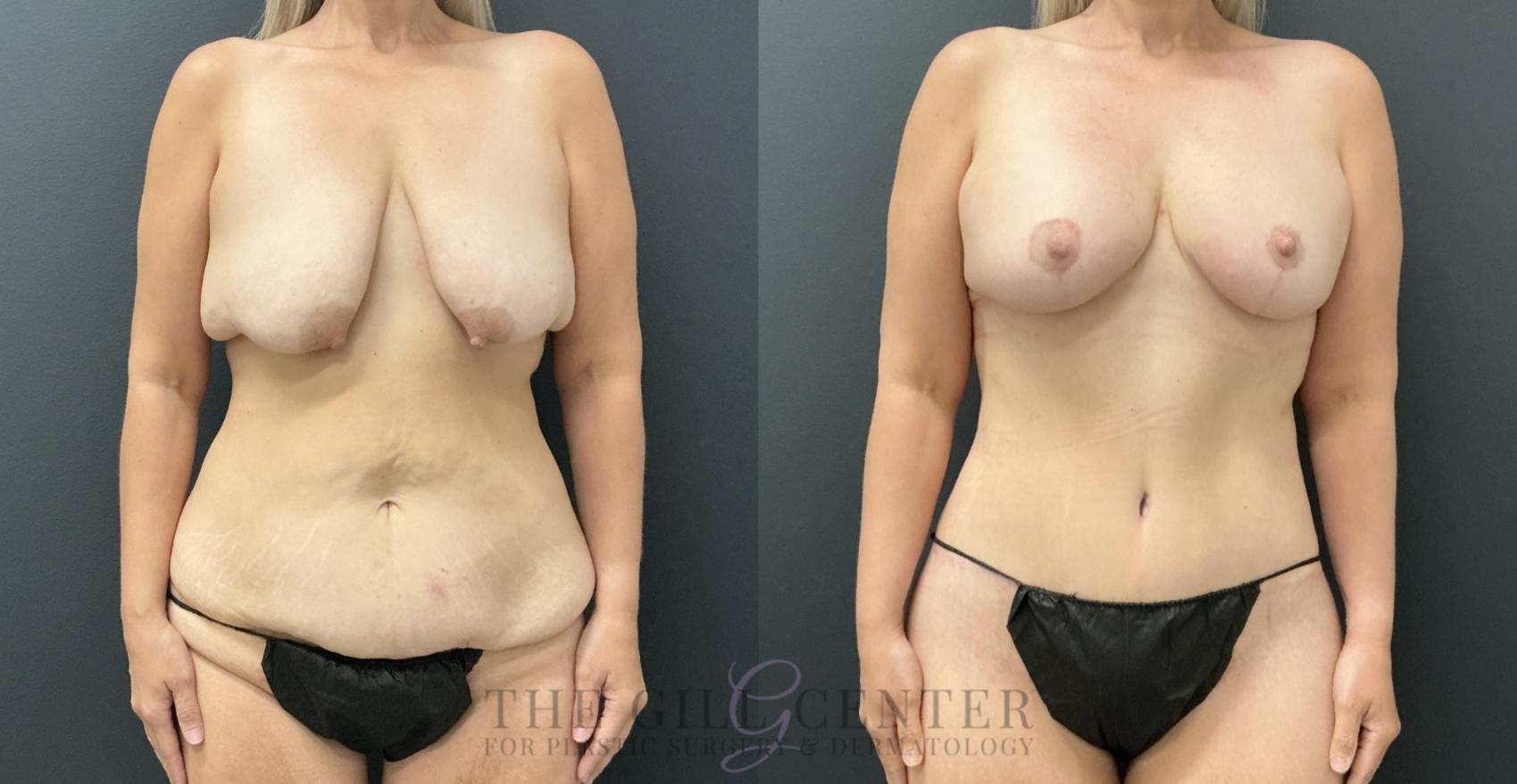 Mommy Makeover Case 791 Before & After Front | The Woodlands, TX | The Gill Center for Plastic Surgery and Dermatology