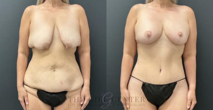Mommy Makeover Case 791 Before & After Front | The Woodlands, TX | The Gill Center for Plastic Surgery and Dermatology