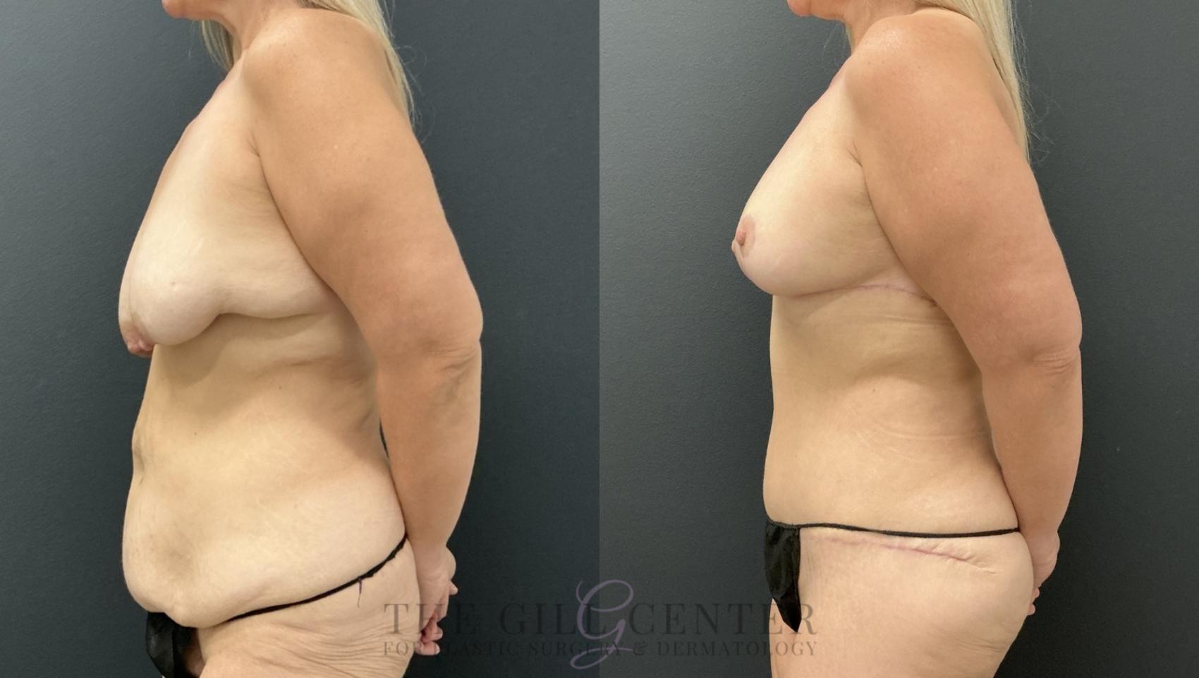 Mommy Makeover Case 791 Before & After Left Side | The Woodlands, TX | The Gill Center for Plastic Surgery and Dermatology