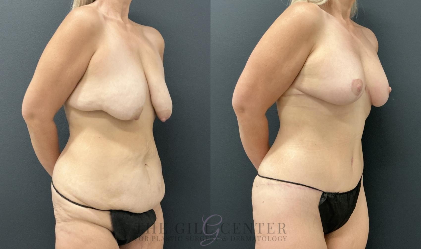 Mommy Makeover Case 791 Before & After Right Oblique | The Woodlands, TX | The Gill Center for Plastic Surgery and Dermatology