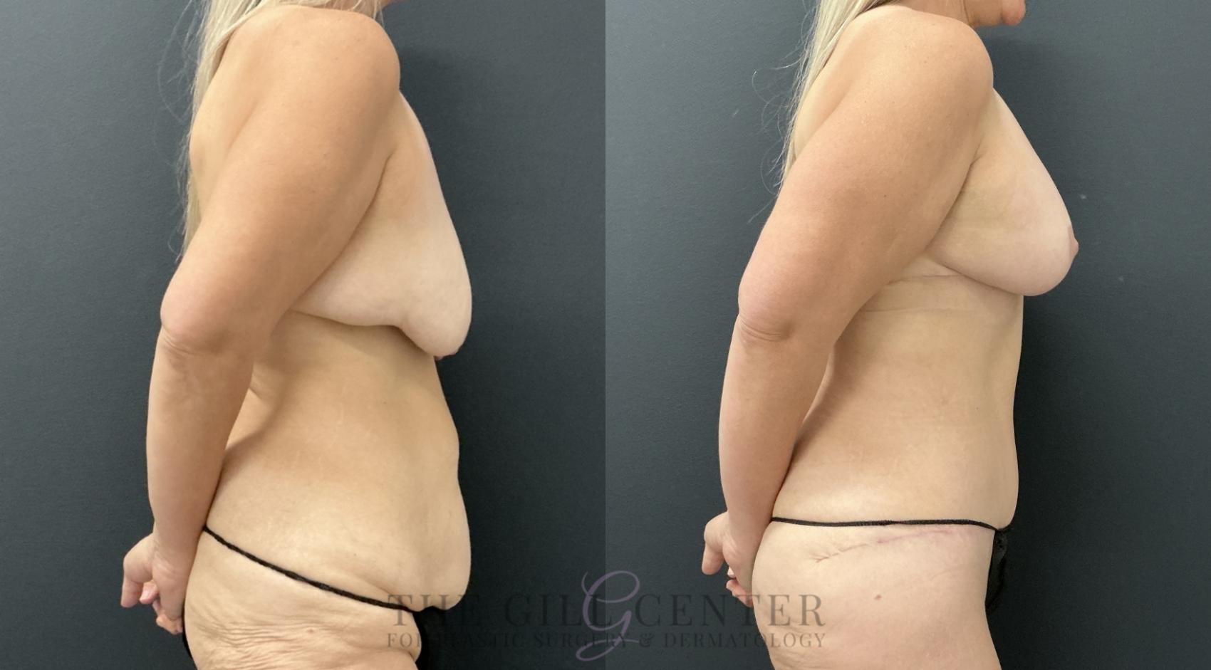 Mommy Makeover Case 791 Before & After Right Side | The Woodlands, TX | The Gill Center for Plastic Surgery and Dermatology