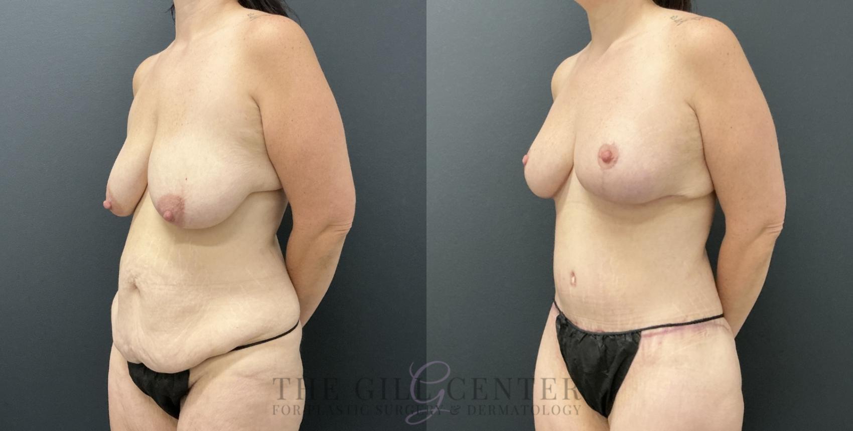 Mommy Makeover Case 793 Before & After Left Oblique | The Woodlands, TX | The Gill Center for Plastic Surgery and Dermatology