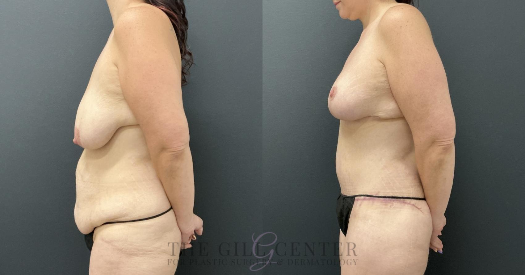Mommy Makeover Case 793 Before & After Left Side | The Woodlands, TX | The Gill Center for Plastic Surgery and Dermatology
