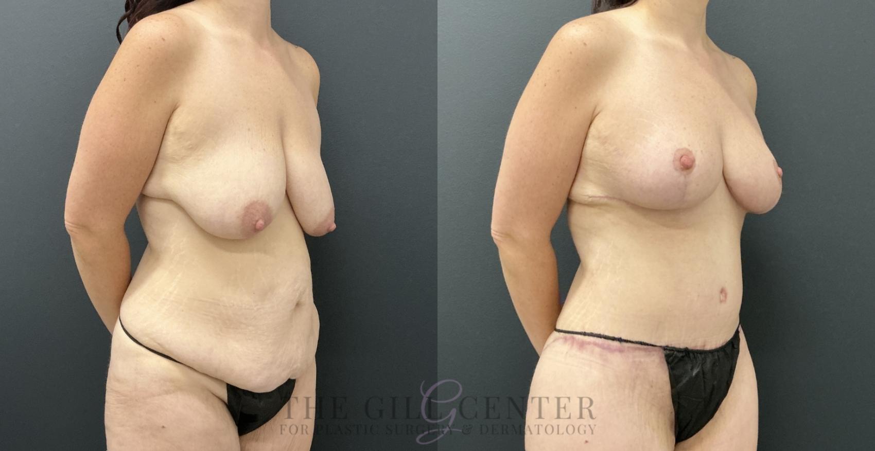 Mommy Makeover Case 793 Before & After Right Oblique | The Woodlands, TX | The Gill Center for Plastic Surgery and Dermatology