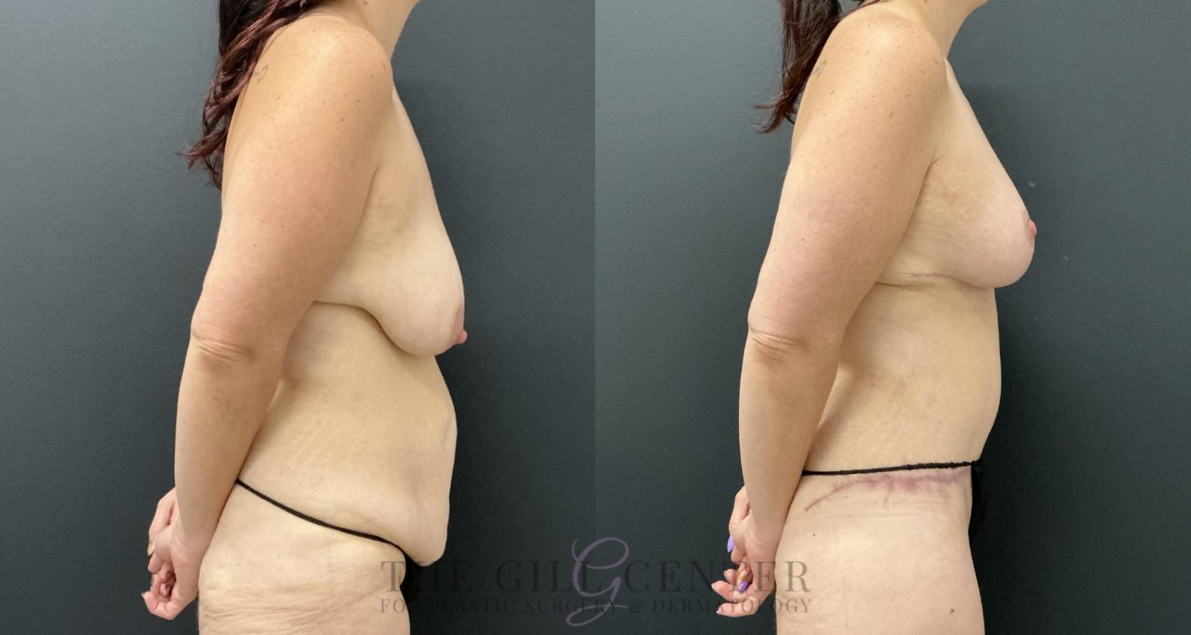 Mommy Makeover Case 793 Before & After Right Side | The Woodlands, TX | The Gill Center for Plastic Surgery and Dermatology
