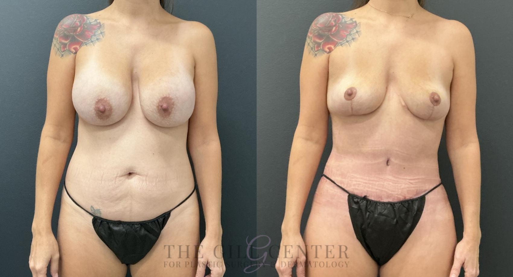 Mommy Makeover Case 795 Before & After Front | The Woodlands, TX | The Gill Center for Plastic Surgery and Dermatology