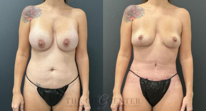 Mommy Makeover Case 795 Before & After Front | The Woodlands, TX | The Gill Center for Plastic Surgery and Dermatology