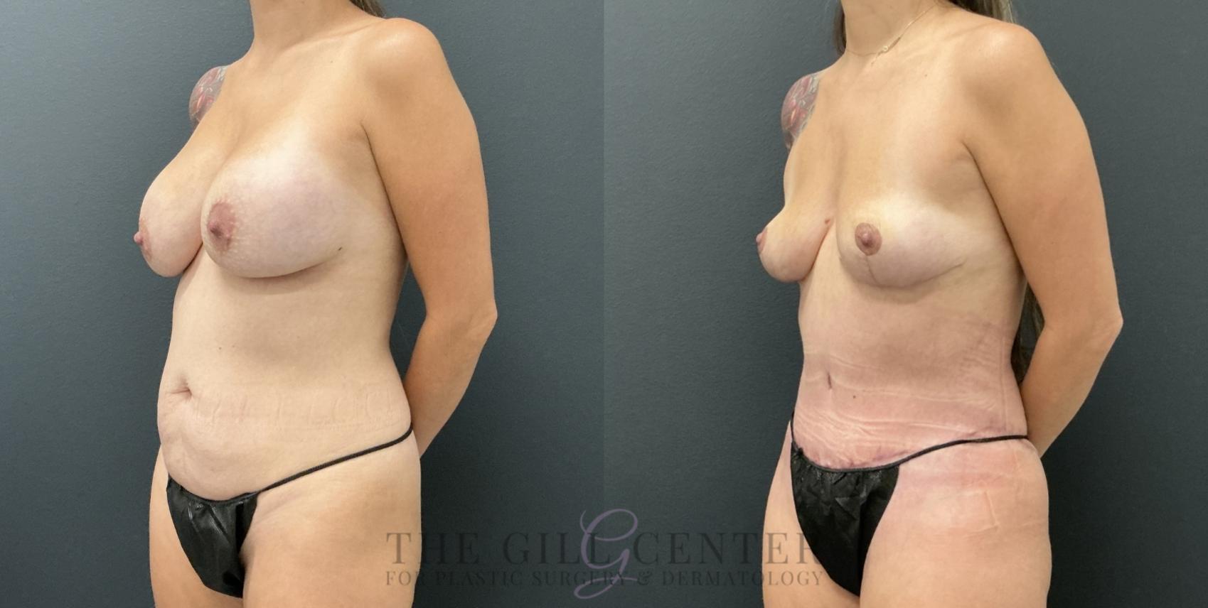 Mommy Makeover Case 795 Before & After Left Oblique | The Woodlands, TX | The Gill Center for Plastic Surgery and Dermatology