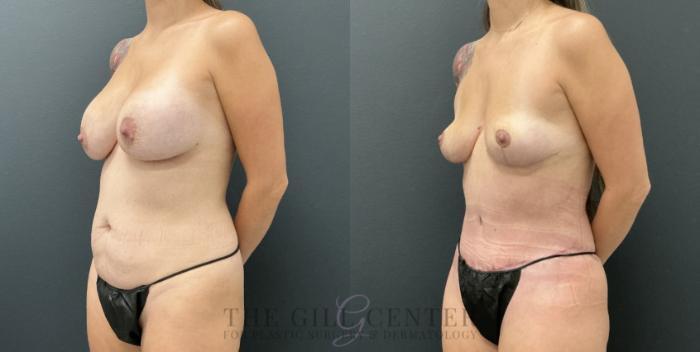 Mommy Makeover Case 795 Before & After Left Oblique | The Woodlands, TX | The Gill Center for Plastic Surgery and Dermatology