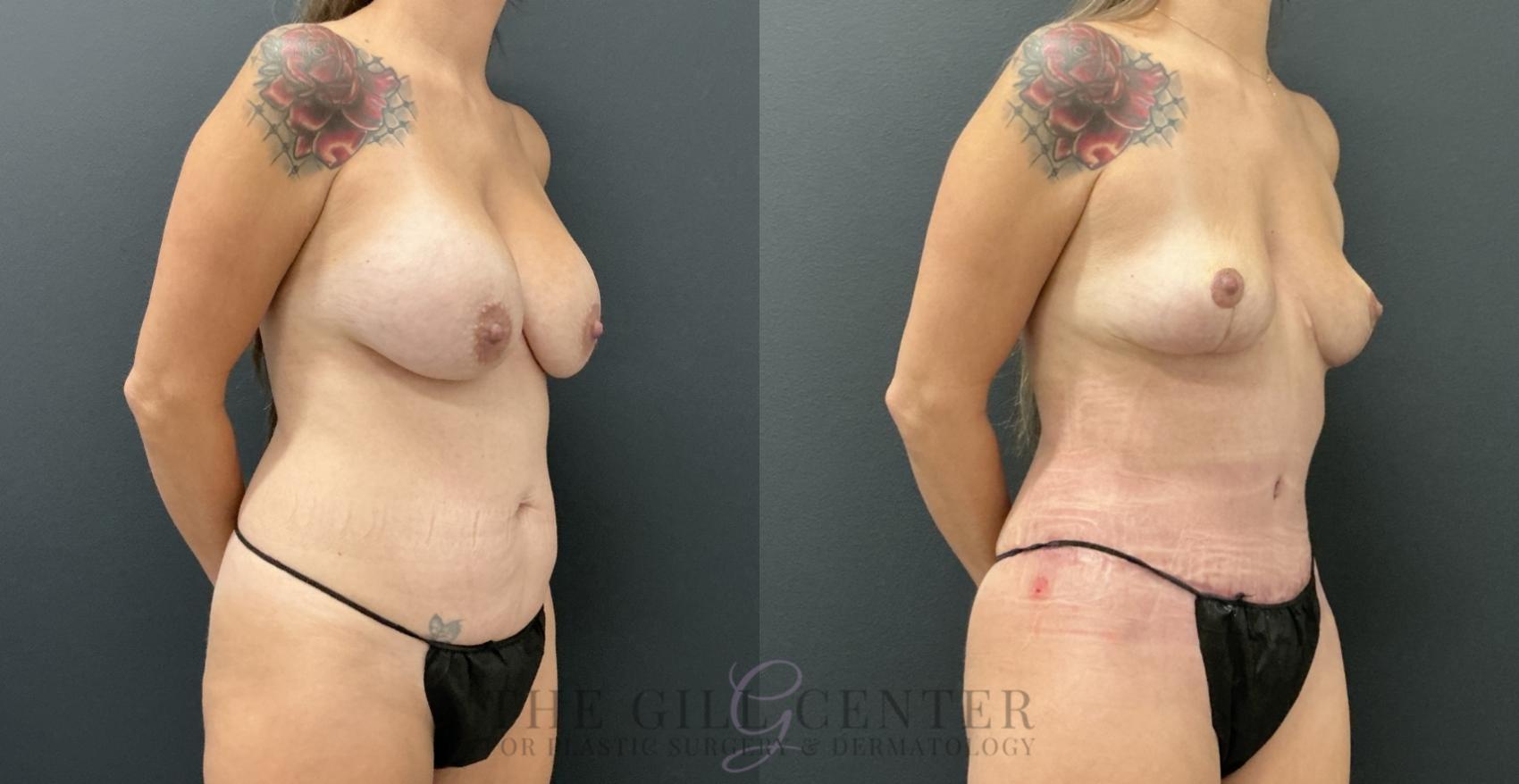 Mommy Makeover Case 795 Before & After Right Oblique | The Woodlands, TX | The Gill Center for Plastic Surgery and Dermatology