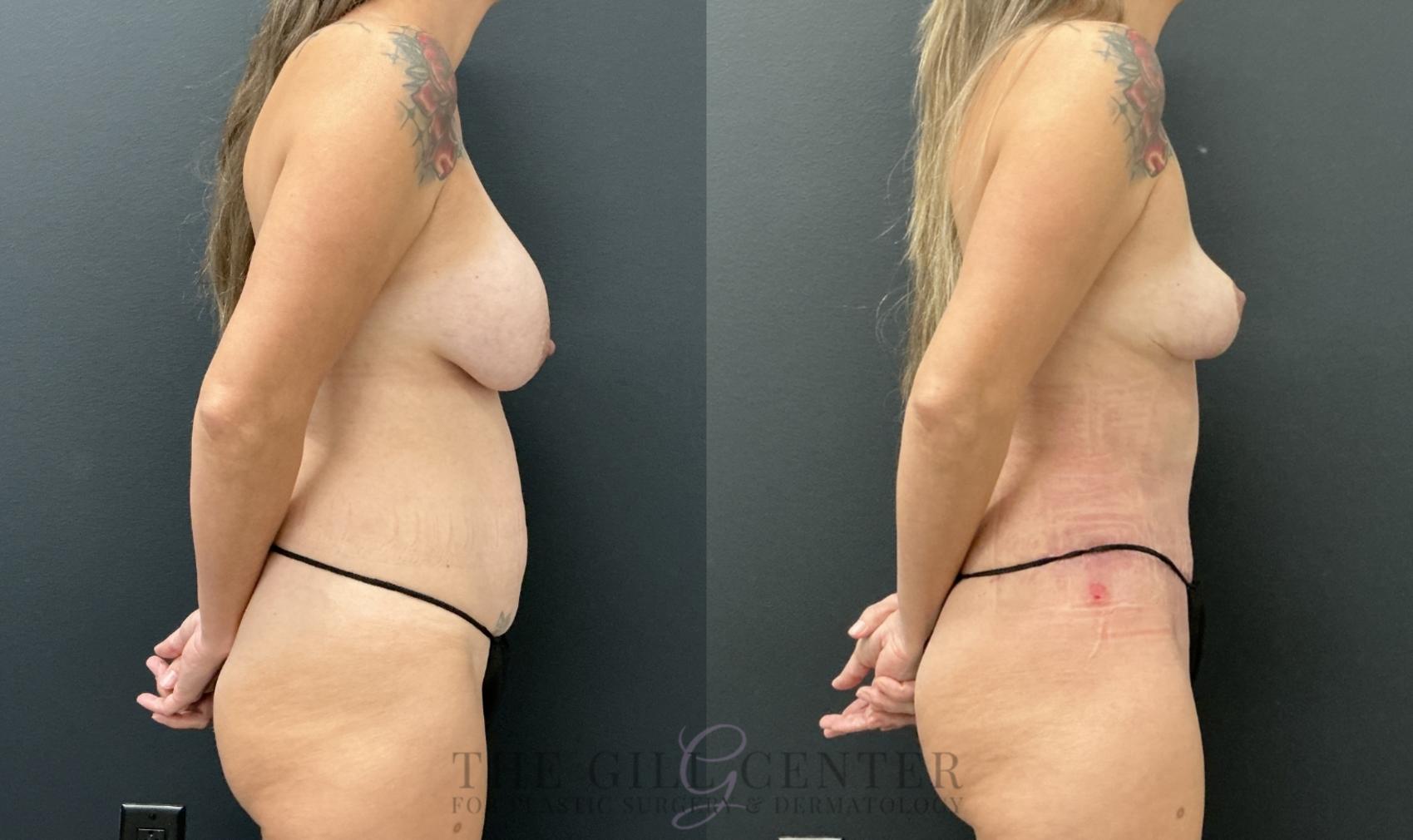 Mommy Makeover Case 795 Before & After Right Side | The Woodlands, TX | The Gill Center for Plastic Surgery and Dermatology