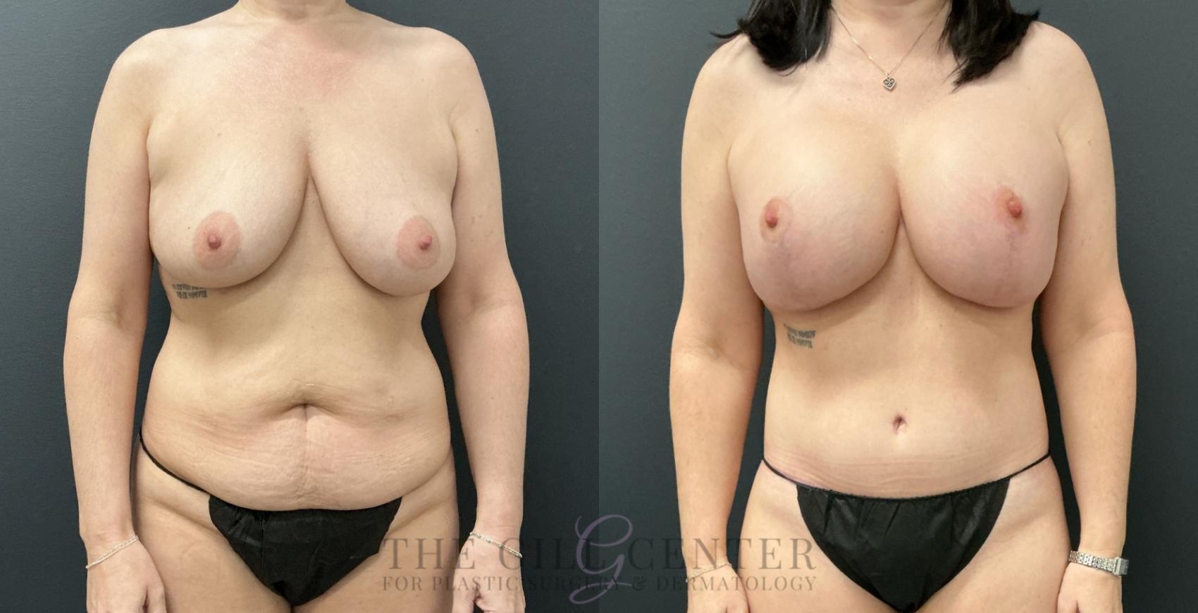 Mommy Makeover Case 821 Before & After Front | The Woodlands, TX | The Gill Center for Plastic Surgery and Dermatology