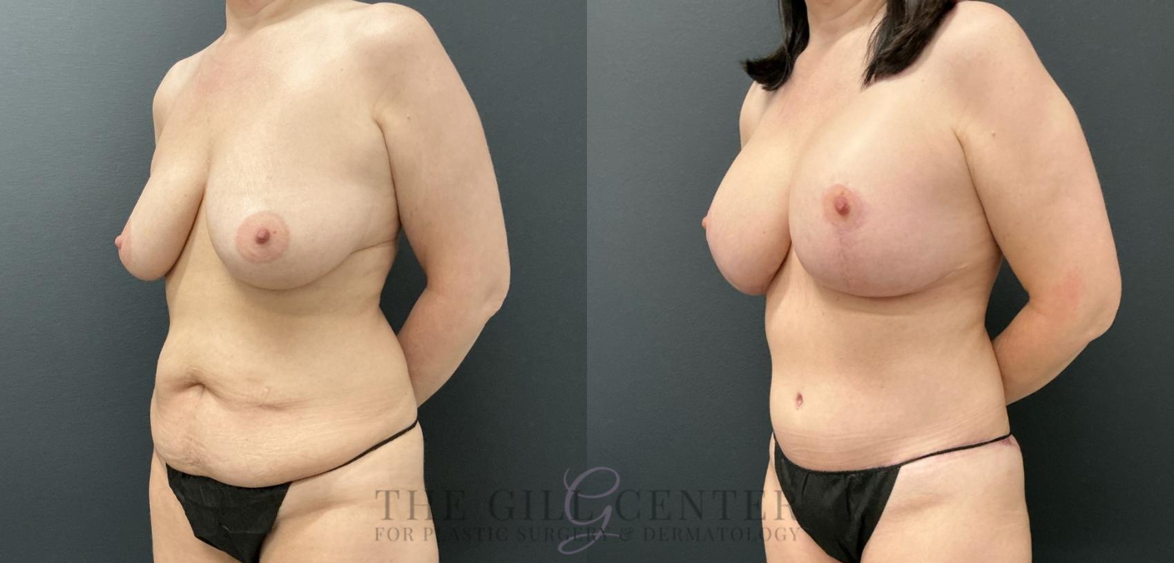 Mommy Makeover Case 821 Before & After Left Oblique | The Woodlands, TX | The Gill Center for Plastic Surgery and Dermatology