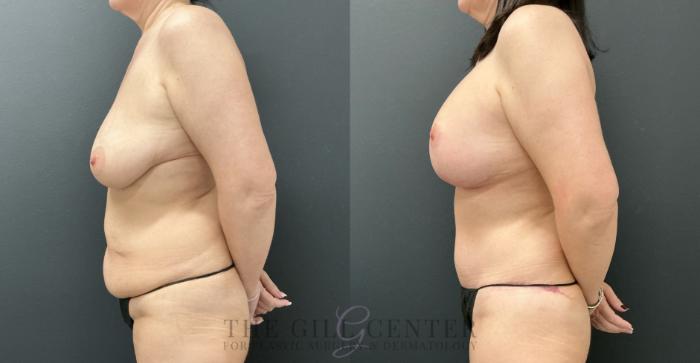 Mommy Makeover Case 821 Before & After Left Side | The Woodlands, TX | The Gill Center for Plastic Surgery and Dermatology