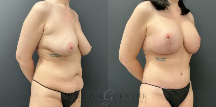 Mommy Makeover Case 821 Before & After Right Oblique | The Woodlands, TX | The Gill Center for Plastic Surgery and Dermatology