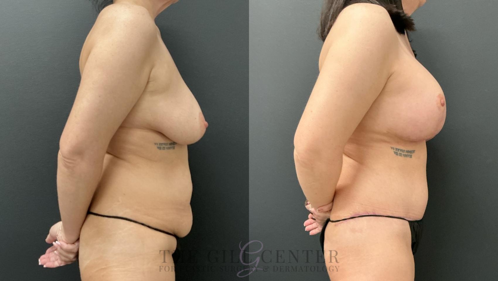 Mommy Makeover Case 821 Before & After Right Side | The Woodlands, TX | The Gill Center for Plastic Surgery and Dermatology