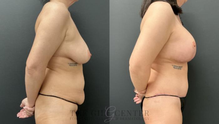 Mommy Makeover Case 821 Before & After Right Side | The Woodlands, TX | The Gill Center for Plastic Surgery and Dermatology