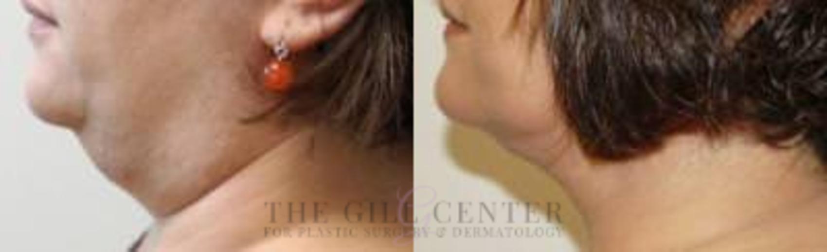 Neck Liposuction Case 367 Before & After Left Side | The Woodlands, TX | The Gill Center for Plastic Surgery and Dermatology