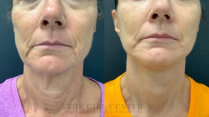 Neck Liposuction Case 526 Before & After Front | The Woodlands, TX | The Gill Center for Plastic Surgery and Dermatology