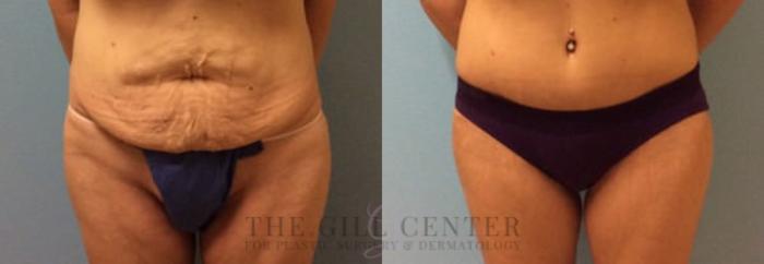 Thigh Lift Case 163 Before & After Front | The Woodlands, TX | The Gill Center for Plastic Surgery and Dermatology